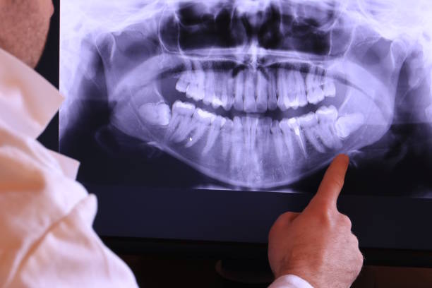 Best Emergency Root Canal Treatment in Chisholm, ME