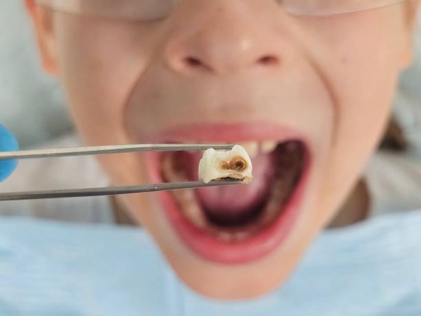 Best Emergency Treatment for Toothache in Chisholm, ME